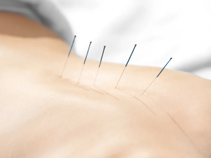 Acupuncture at HealthSource of Harvest in HARVEST