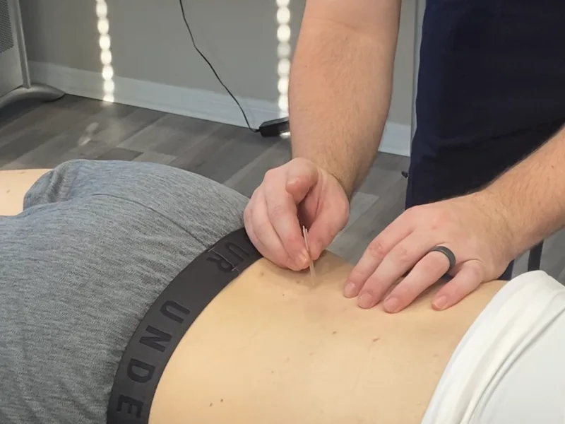 How Dry Needling works at HealthSource of Harvest