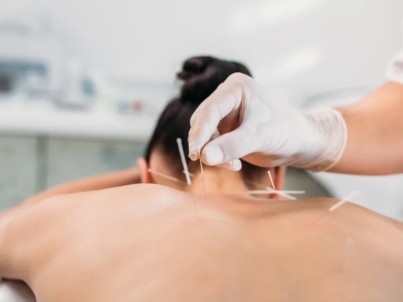 Dry Needling at HealthSource of Harvest in HARVEST
